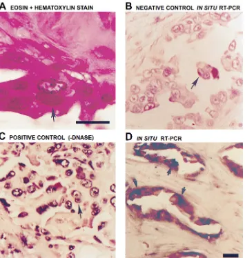 Figure 5. MAP kinase is hyperex-pressed in primary breast cancer and metastasis to the lymph node: immu-nohistochemical analysis