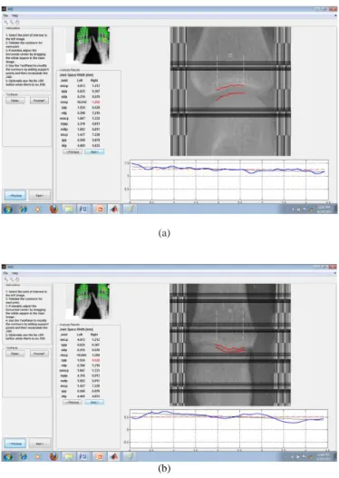 Fig -9: (a) &amp; (b) shows marking of upper and lower margin  of phalangeal  joints along with JSW measurement 