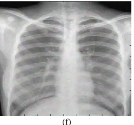Figure 4. (a) Original X-ray image. (b) Noisy image. (c) Denoised  image  using  Visu  shrink