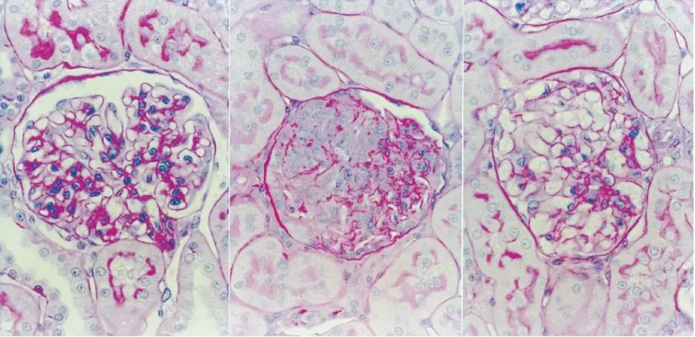 Figure 3. Histologic PAS stain of glomeruli from group A, controls (left); ATS-injected and untreated, group B (center); (right) ATS-injected and treated with PDE isozyme inhibitors, group C