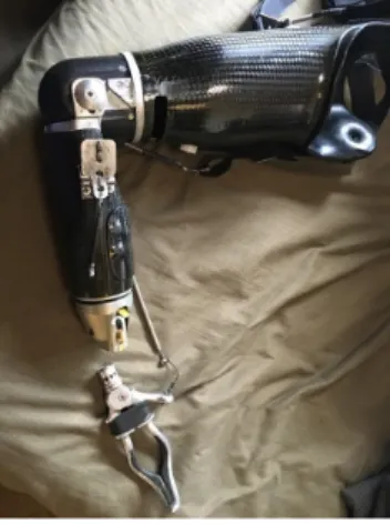 Figure 6: Cassie’s Current Transhumeral Prosthesis 