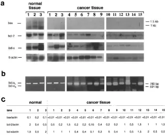 Table I. Expression of Members of the bcl-2 Family in Normal and Malignant Breast Tissue