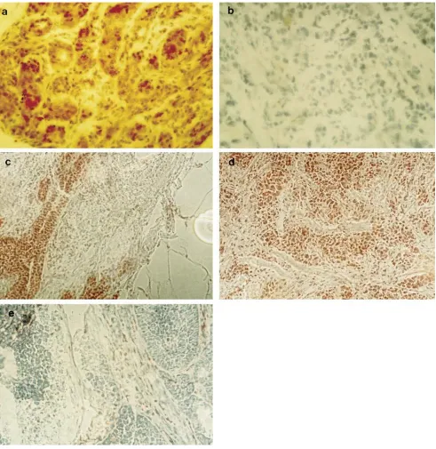 Figure 2. Immunohistological analysis of bax expression in normal and malignant breast epithelium