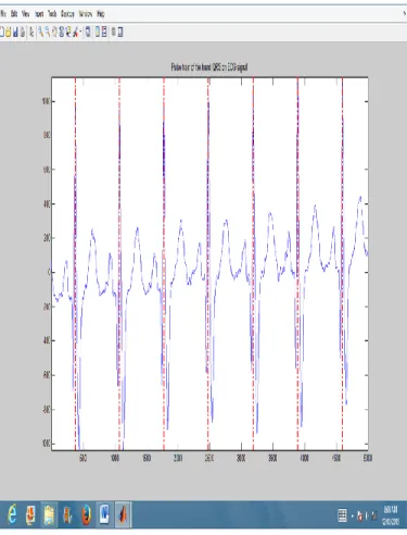 Figure  6  Output  of  QRS  Detection  using  Pan- Pan-Tompkins Algorithm 
