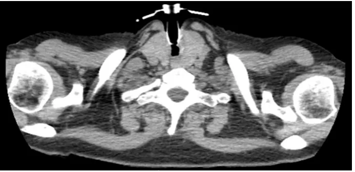 Fig. 2 The control chest computed tomography: silicone stent implanted into the trachea