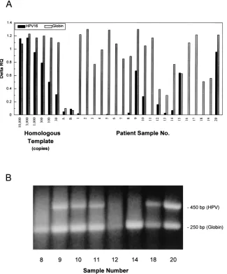 FIG. 4. (A) Analysis of patient samples by HPV-16–globin multiplex assay. Patient samples were ampliﬁed in a multiplex assay that contained the primers andprobes for both HPV-16 and globin