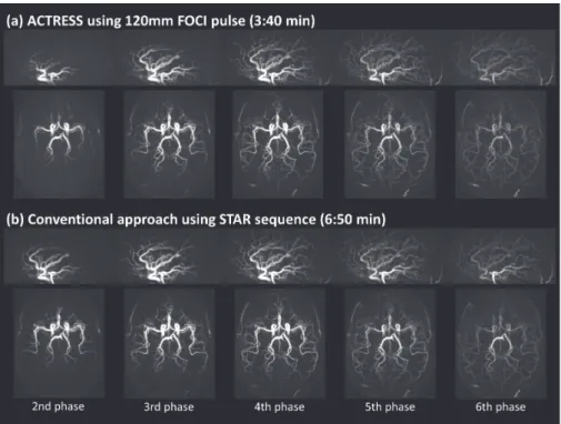 Figure 6: Example images of ACTRESS-MRA and conventional 4D-MRA using the STAR sequence.