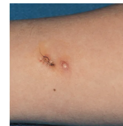 FIG. 1. Nodular cutaneous aspergillosis in a patient with AIDS. The patienthad two nodules on the right forearm that arose under an occlusive dressing