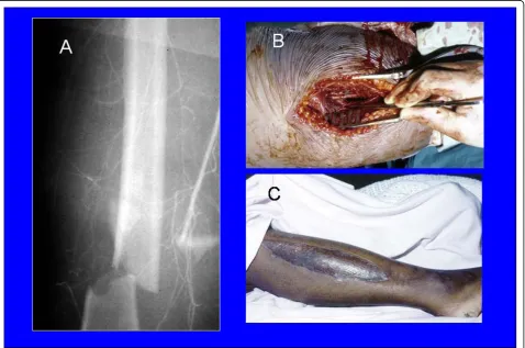 Figure 3 A 24-years front seat female passenger who sustained fracture right femur with femoral artery injury (A) that neededvenous interposition graft (B) and a fasciotomy of the right leg (C).