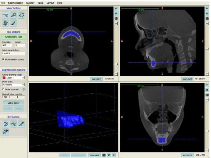 Figure 1 -  Mandibular Mask Region of Interest (ROI) segmentation.  Mandibular regional voxel  based registration was performed using a ROI created from each time point