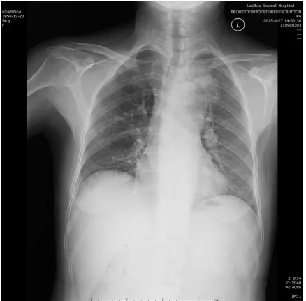 Figure 3. A chest X-ray showed left widened mediastinum and an irregular shadow on the outside the top of left lung and aortic arch.