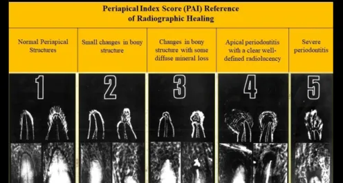 Fig. 1. Periapical Index (PAI) Score Reference by Dag Orstavik (6) describing the radiographic  healing status of the periapical tissues correlated to histology
