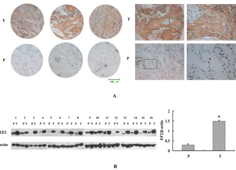 Figure 2: EF2 expression in LSCC tissues and peri-cacinoma lung tissues by western blot and IHC analysis