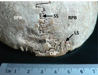 Figure 1. Posterior view of the skull vault with the presence of the sutural bone. WB –