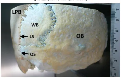 Figure 2. Side view of the skull with the presence of the sutural bone. WB – Wormian bone,