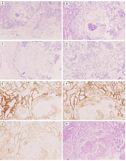Figure 3. Pathological findings of PAB in case two. A-D: Hematoxylin and eosin (H&E) staining findings