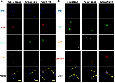 Figure 4: Immunofluorescence microscopic characterization of CTCs. A. DAPI (blue), anti-CA9 (red), anti-CD147 (green) and anti-CD45 (orange) antibodies were used to stain nuclei, CA9, CD147 and WBCs, respectively