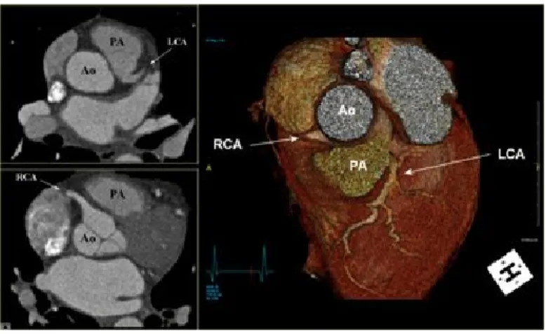 Figure 9 ALCAPA Coronary Anomaly 9