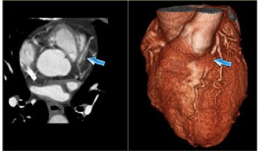 Figure 10 Myocardial Bridging Coronary Anomaly 9