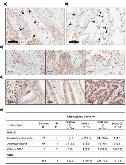Figure 7: Immunohistochemical analysis of ATM protein expression in lung tissue, NSCLC and CRC samples