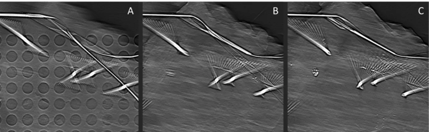 Figure 2. 8. Examples of the “slinky” appearance of metal artifact in stationary digital breast  tomosynthesis (sDBT) images of a lumpectomy specimen containing metal needles and wires  used to guide biopsy