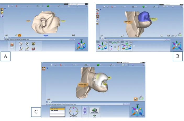 Figure 2.2. Planmeca Emerald scan for restoration fabrication. A, Initial scan of prepared tooth