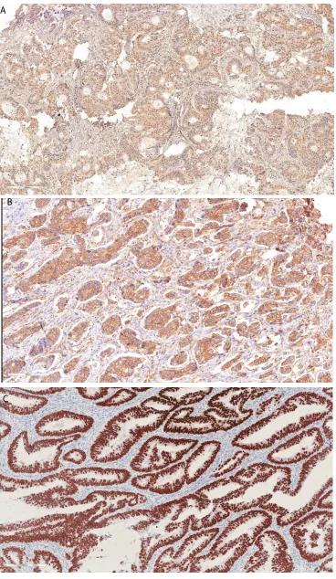 Figure 1: Representative immunohistochemical staining of survivin and p53. Positive survivin immunoreactivity in tumor cells (nuclear survivin, A; cytoplasmic survivin, B) and positive p53 expression in tumor cells (C)