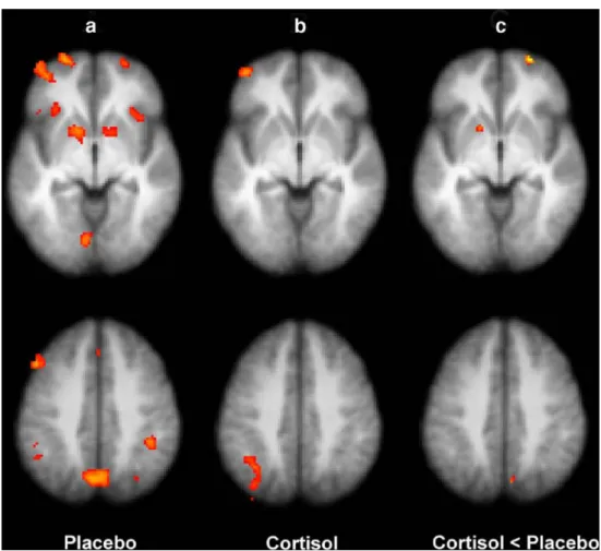 Fig. 2 Coronal slices showing significant  hydrocortisone-in-duced decreases in activation as compared with placebo in left and right hippocampus (z>2.3, uncorrected p)