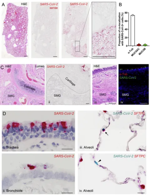 Figure S5. SARS-CoV-2 infection in SARS-CoV-2 autopsy lungs, related to Figure 7