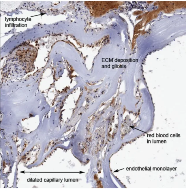 Figure 1.1: Histopathology of a CCM lesion. Note loss of normal vascular 