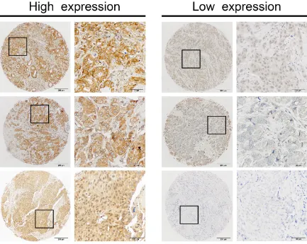 Figure 1: Identification of miR-454 in primary tumors by in situ hybridization (ISH). Representative IHC staining of high and low miR-454 expression is presented at 400× magnification and 100× magnification.