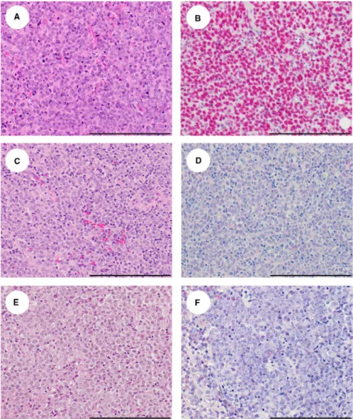 FIGURE 2  Morphologic findings  and EBER stains in representative DLBCL  from HIV‐positive patients in Malawi