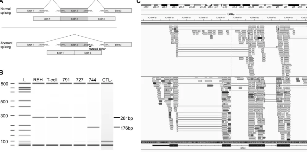 Figure 4: Mutation g.chrX:70339329T>C in MED12 causes the splicing of exon 2. (A) Schematic representation of the normal (top) and aberrant splicing (bottom) of MED12 transcripts from the normal and the identified mutant gene