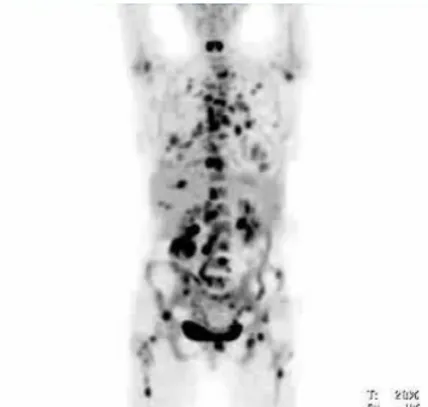 Figure 1. PET image (from a whole‑body 18F‑FDG‑PET–CT scan) of a 47‑year‑old woman. 