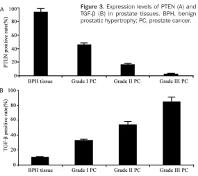 Figure 1. PTEN staining images. A. BPH tissues; B. Grade I prostate cancer; C. Grade II prostate cancer; D