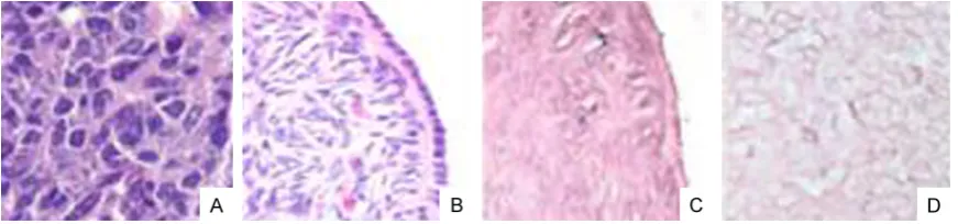 Figure 4. ISH images. A. BPH tissues; B. Grade I prostate cancer; C. Grade II prostate cancer; D