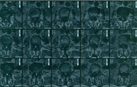 Figure 1and partially of the thoracic spineMagnetic Resonance Imaging scan (MRI) mainly of the lumbar Magnetic Resonance Imaging scan (MRI) mainly of the lumbar and partially of the thoracic spine