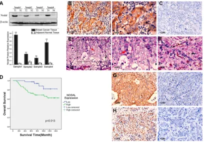 Figure 1: Expression of Nodal correlates with vasculogenic mimicry (VM) and poor prognosis in human breast cancer samples