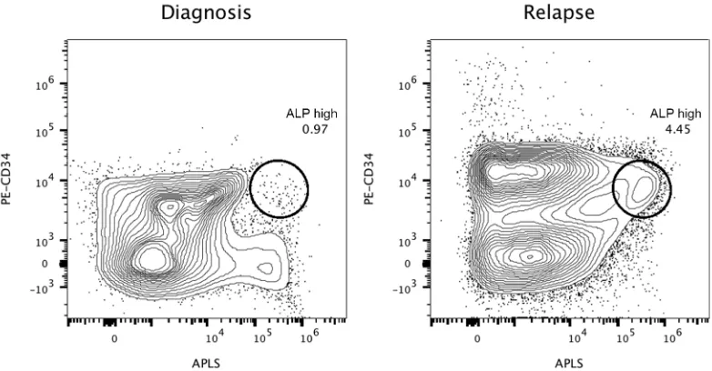Figure 4: Alkaline phosphatase activity is not restricted to CD34-positive cells. Figure (A) represents the alkaline phosphatase test of a bone marrow aspirate from a 61-year-old patient with myelodysplastic syndrome developed into acute myeloid leukemia