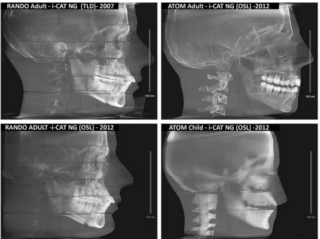 Figure 3 Lateral Cephalometric View of Scans for Verification Phantom Position 