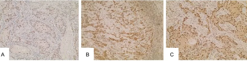 Figure 2. Expression of ADAR1 in moderately differentiated oral cancer, positive staining was localized in the nu-cleus and cytoplasm