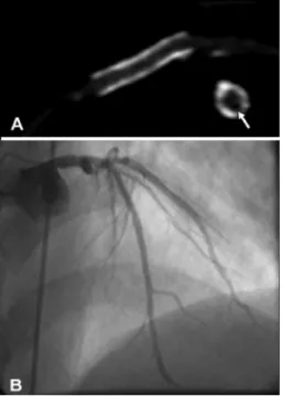 figure  3.  Patent  thin-strut,  non–drug-eluting  stent  (diameter,  3.5  mm)  placed  in  the  left  anterior  descending  coronary  artery  of  a  46-year-old  man