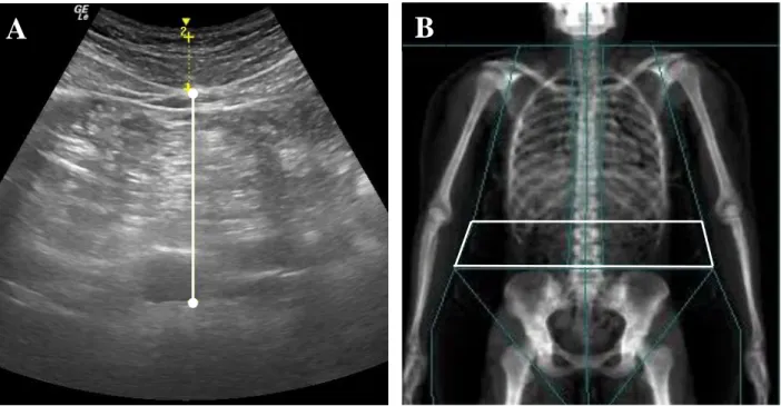 Figure 3:  Measurements of VAT.  (A) Abdominal US scan; VAT US  thickness was measured  between the interior border of the rectus abdominis and the posterior wall of the aorta