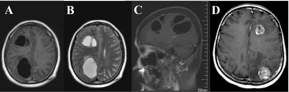 Figure 2: Typical characteristics of cystic versus solid brain metastases observed in MRI images