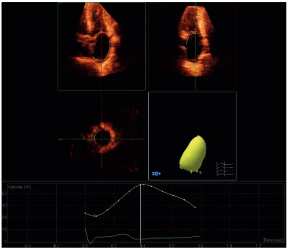 Figure 4. Assessment of LA volumes using RT3DE. Automatic border detection (yellow line) is obtained marking 5 reference points in the apical  2- and 4-chamber views (upper panel) and manual corrections can be made to exclude the LA appendage and the pulmo