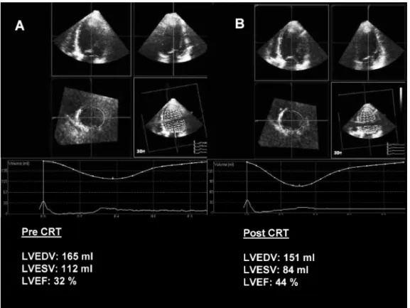 Figure 1. Example of 3D left ventricular (LV) volumes generated by post-processing of a RT3DE dataset, acquired in a patient scheduled for CRT