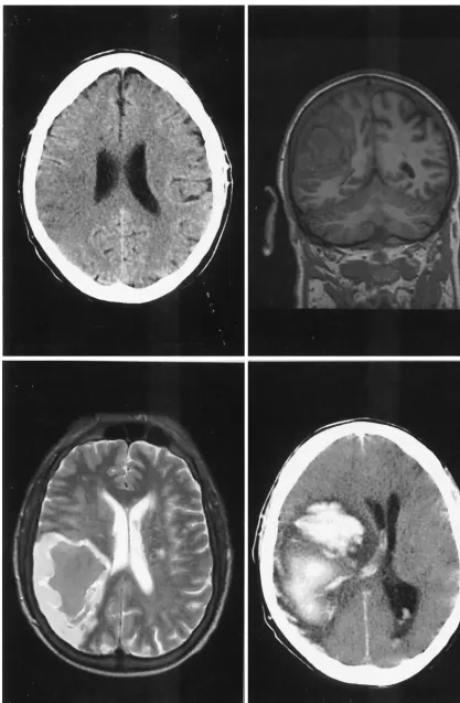FIG. 1. (Upper left) Cerebral computed tomography 21 h after onset of symptoms shows a hypodense area with loss of differentiation betweengray and white matter in the posterior supply area of the right middle cerebral artery