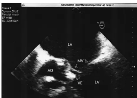 FIG. 2. Transesophageal echocardiogram 6 days after splenectomyshows thickened aortic cusps (AO) with a mobile vegetation (VE)