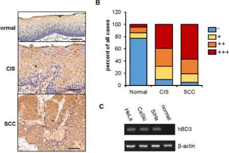 Figure 1: hBD3 expression in cervical cancer tissues and cell lines. A. immunohistochemical staining showing hBD3 expression in normal cervical tissue (n=22), cancer in situ (CIS, n=41), and squamous cervical cancer (SCC, n=37), scale bar, 50 μm