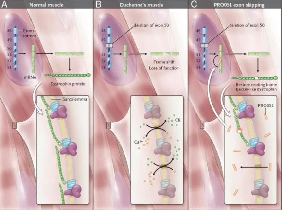 Figure 2.1: An example of the principle of the exon skipping treatment [1]